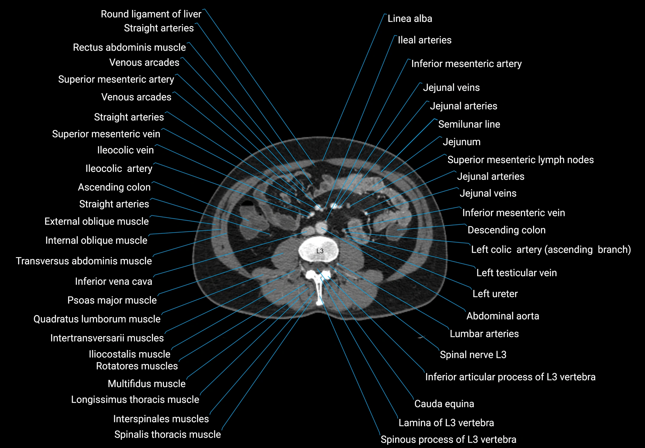 CT male pelvis axial cross sectional anatomy labelled radiology image -00095.webp